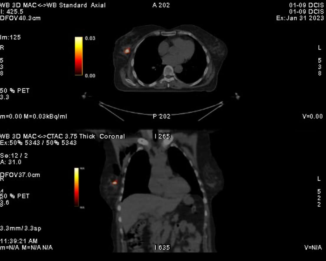DCIS 24 hours post injection PET scan