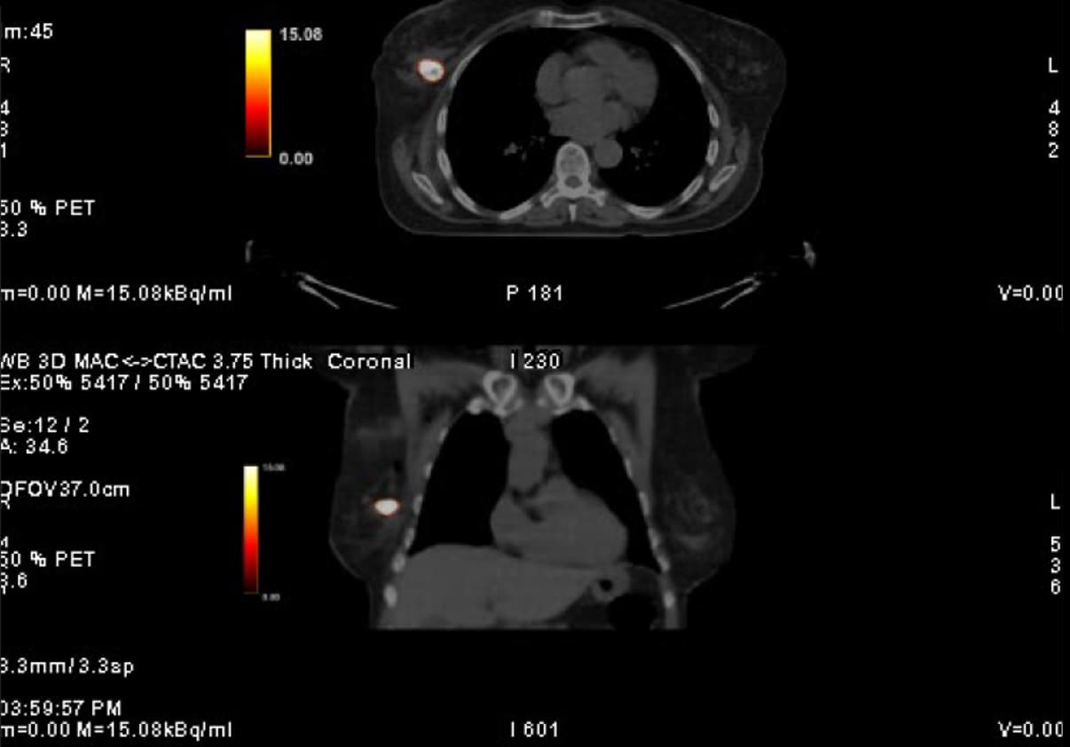 DCIS 7 days post injection PET Y90 scan