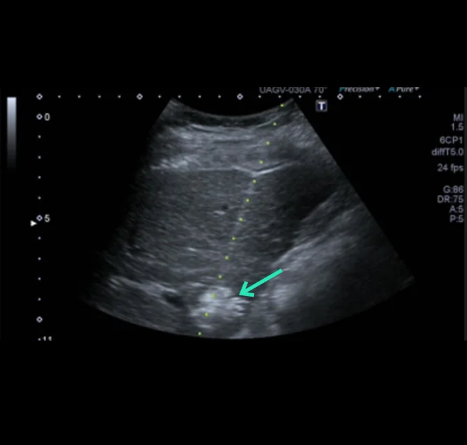 YntraDose Administration Deposition