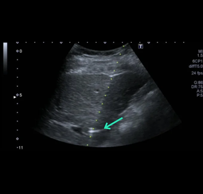 YntraDose Administration Needle Placement