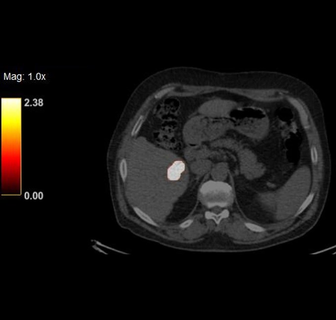 Liver 24 hours post injection transverse view