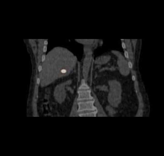 Liver 7 days post injection coronal plane