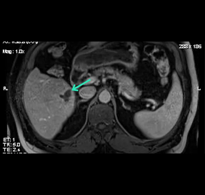 MRI Follow-up Imaging Axial view