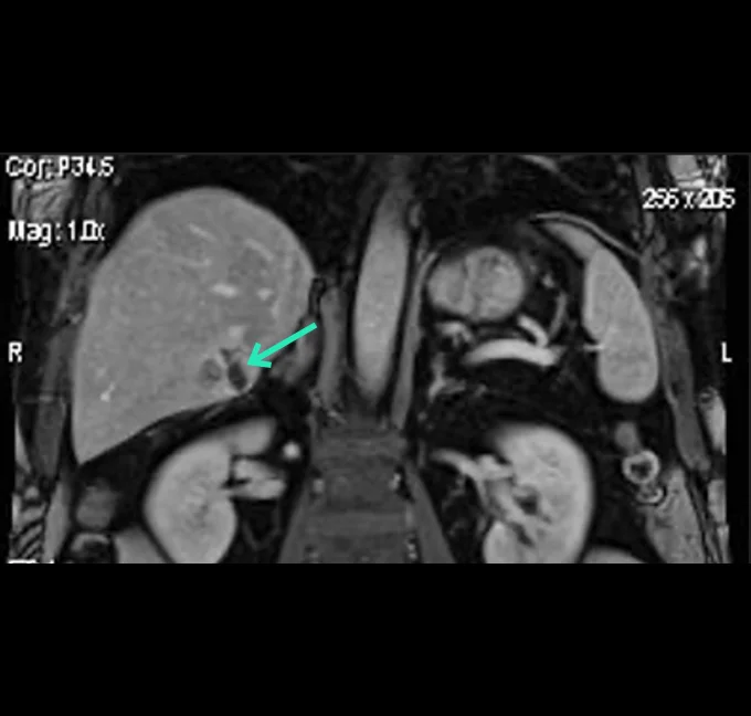 MRI Follow-up Imaging Coronal view