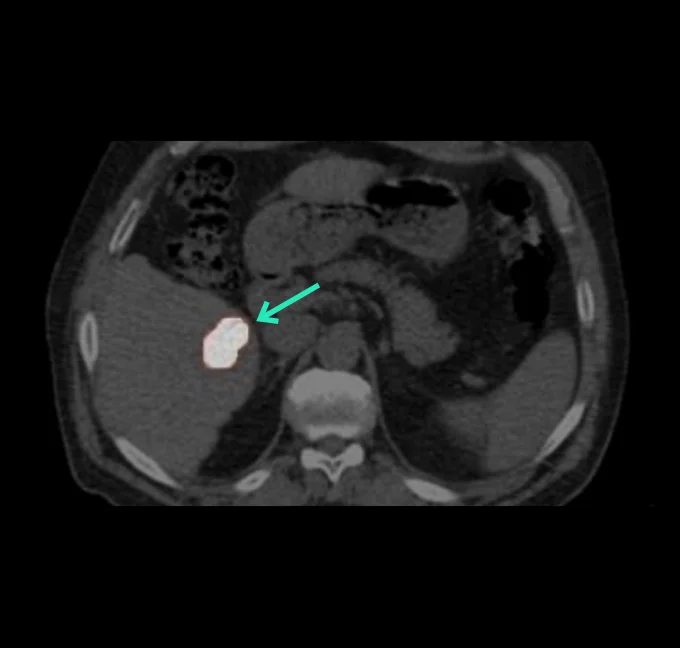 ⁹⁰Y PET Imaging Axial view