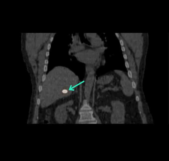 ⁹⁰Y PET Imaging Coronal view