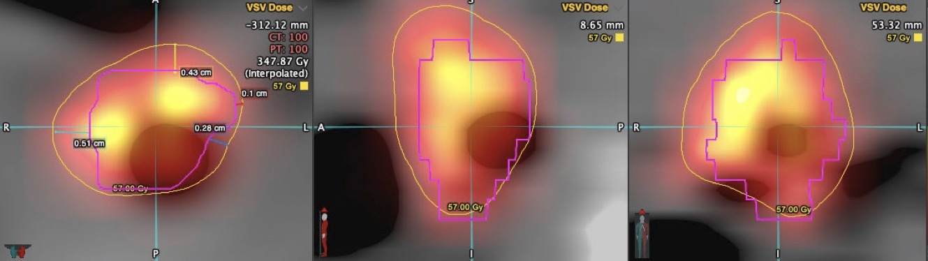 PET/CT imaging showing dose distribution within the implant
