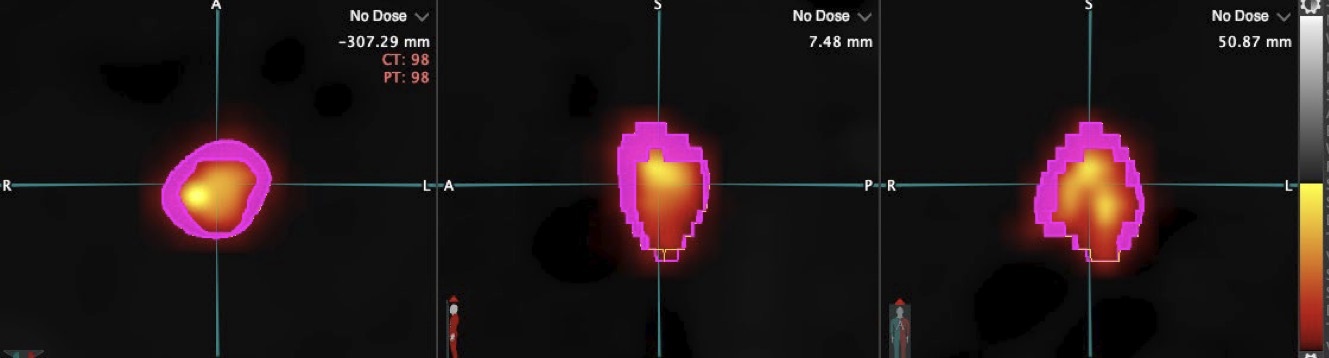 PET/CT imaging showing dose at the implant edge and isodose margin