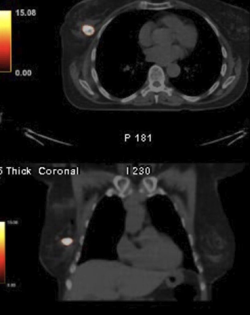 PET/CT scan 24 hours after YntraDose implantation, DCIS case