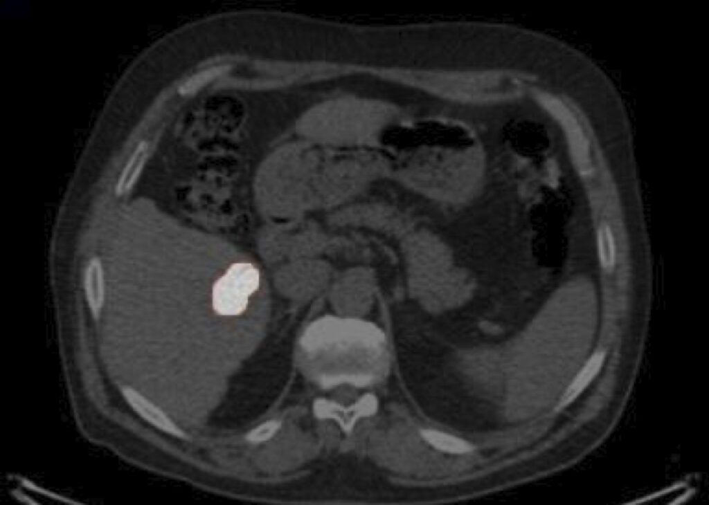 PET/CT scan 24 hours after YntraDose implantation, HCC case